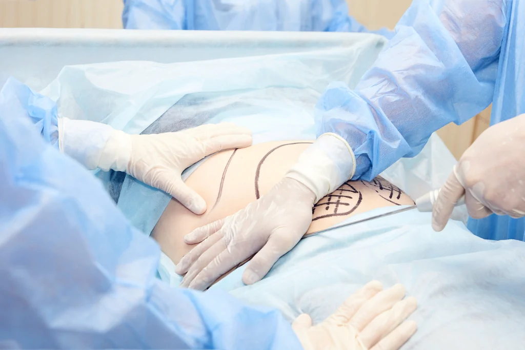 Liposuction in Turkey